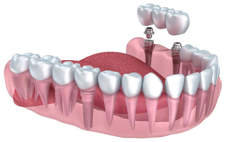 Dental Planet : painless dental implant in chandigarh