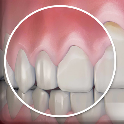 best gums treatment in chandigarh