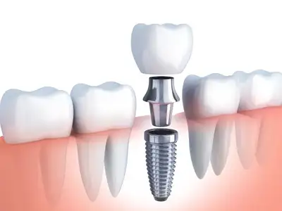 Implantology