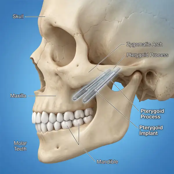 Pterygoid Implants at Dental Planet Mohali