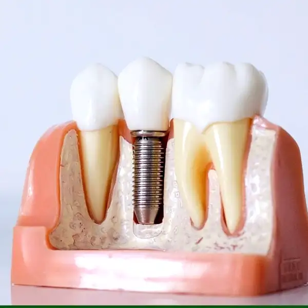 Teeth in 72 Hours at Dental Planet Mohali