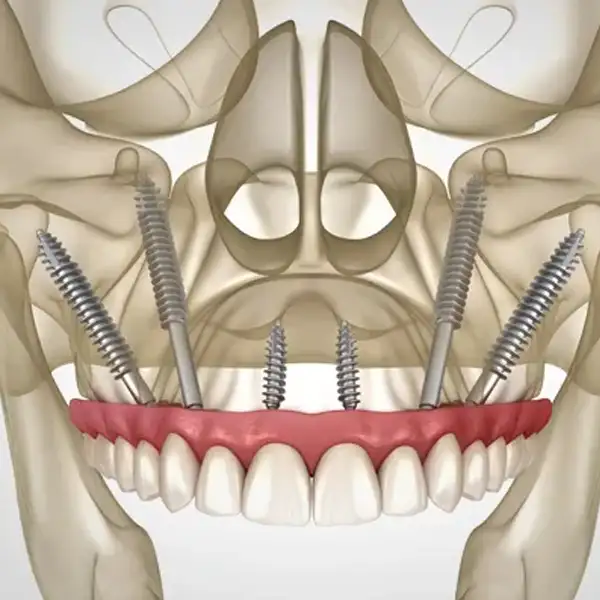 Zygomatic Implants at Dental Planet Mohali